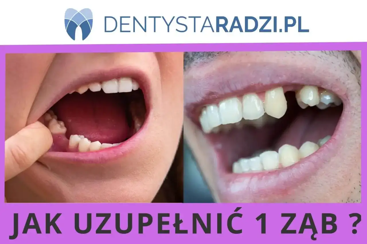 Brak zęba - Co robić? Odbudowa, NFZ i pilna pomoc!