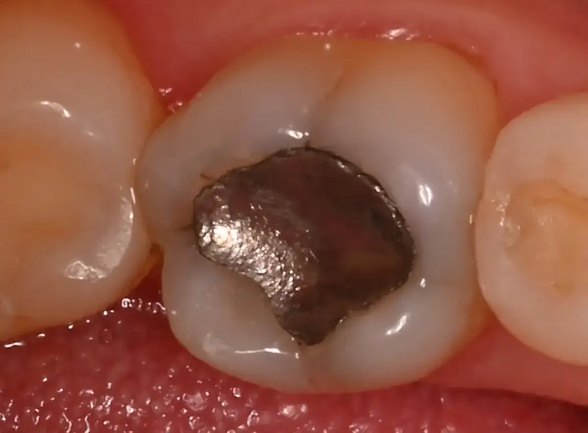 Wypełnienie zęba - Cena, trwałość, rodzaje i co musisz wiedzieć?