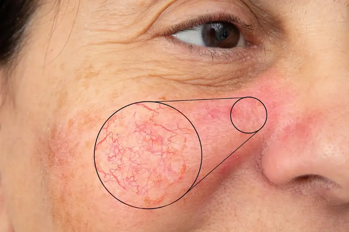 Cera naczynkowa - jak ją wyciszyć i kiedy iść do dermatologa