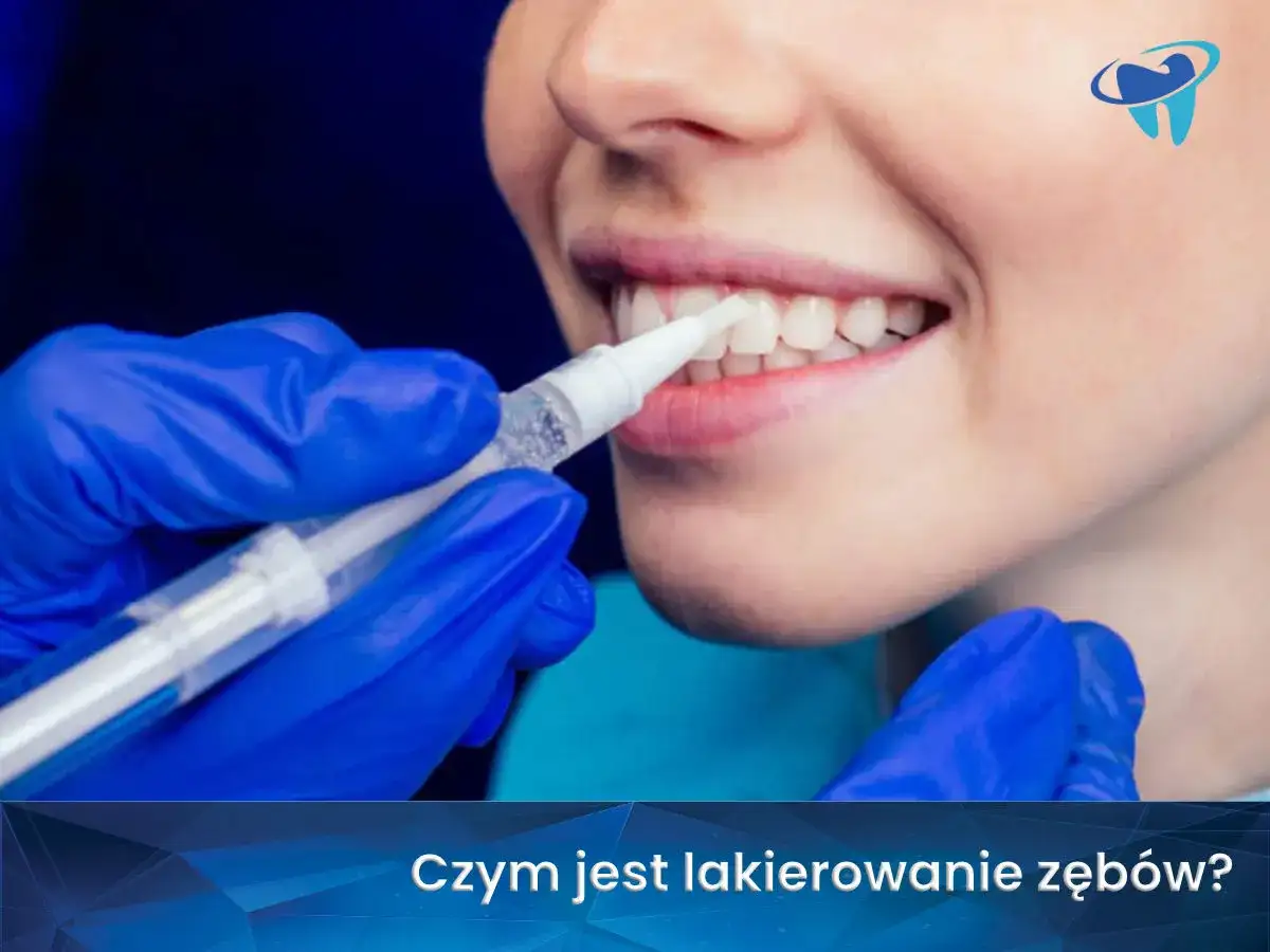 Lakierowanie zębów u dorosłych - kiedy naprawdę pomaga?