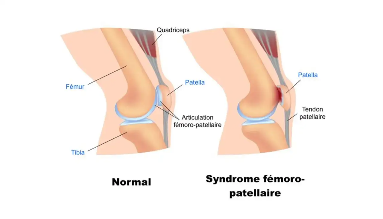 Douleur au genou en descente - Pourquoi et comment soulager ?