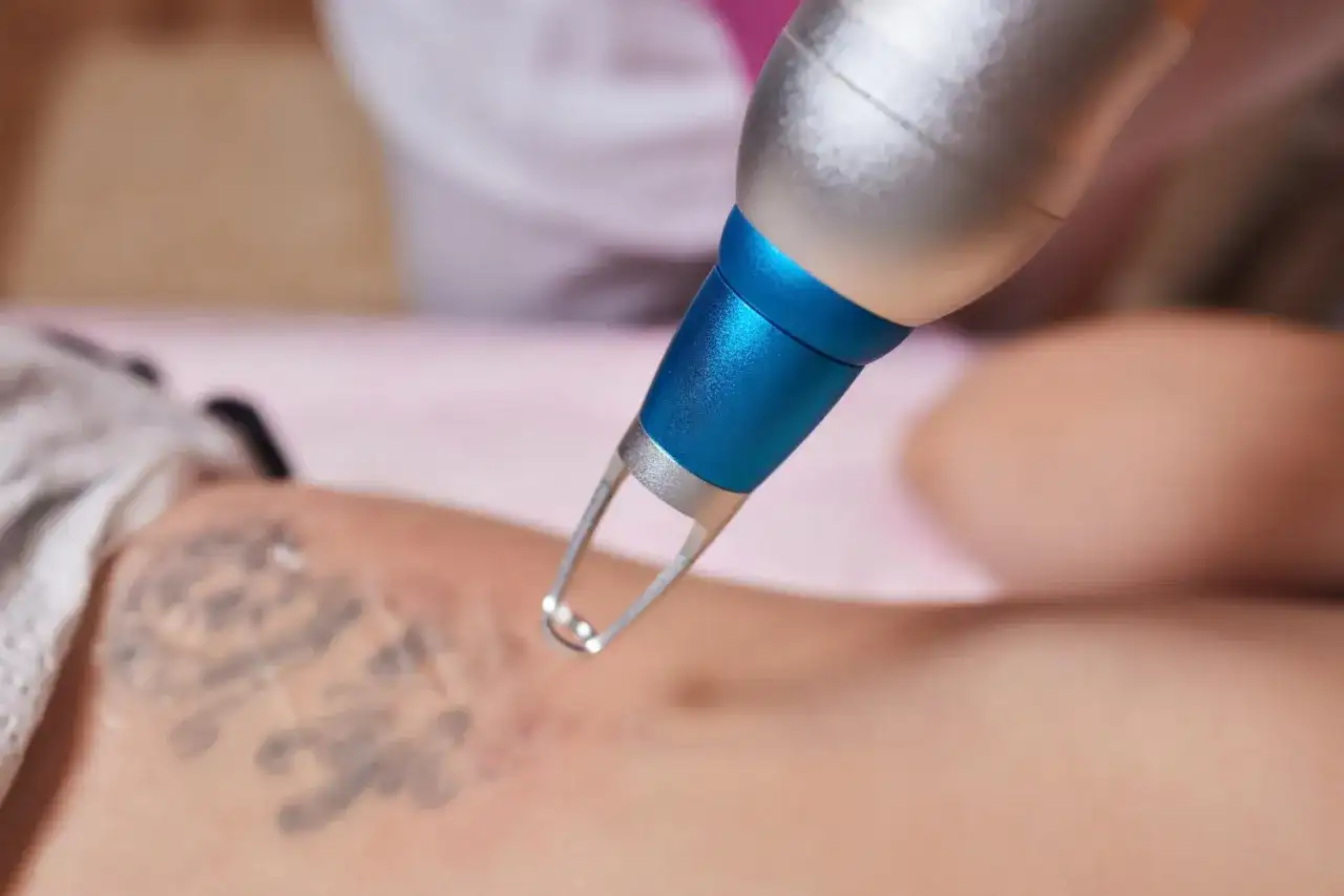 Usuwanie tatuażu i blizn - kiedy laser ma sens?
