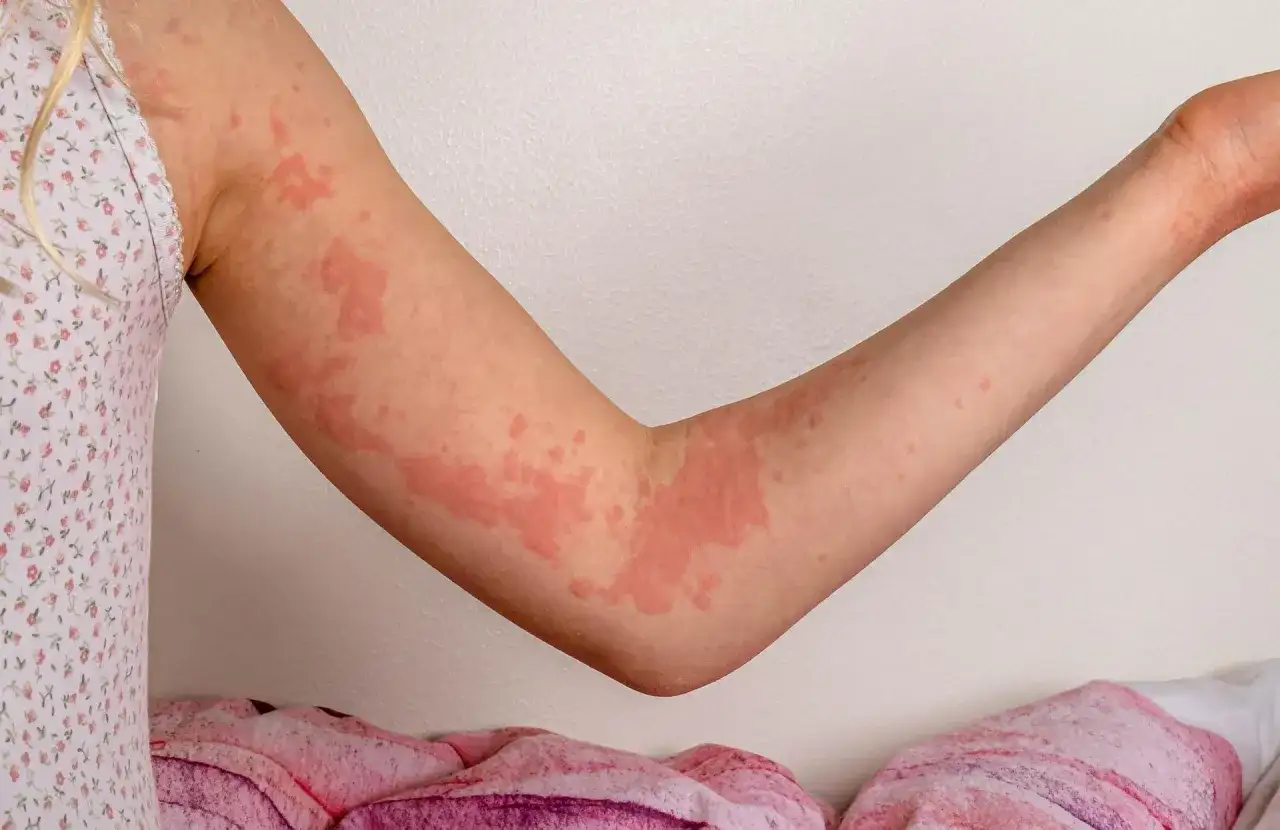 Reakcja alergiczna - Jak rozpoznać i co robić, gdy liczy się czas?