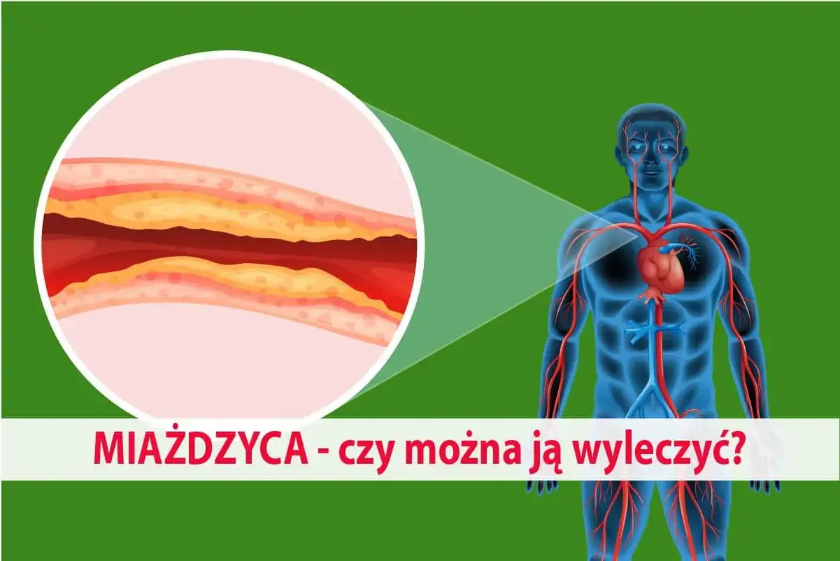 Miażdżyca - objawy, leczenie i jak ją spowolnić?