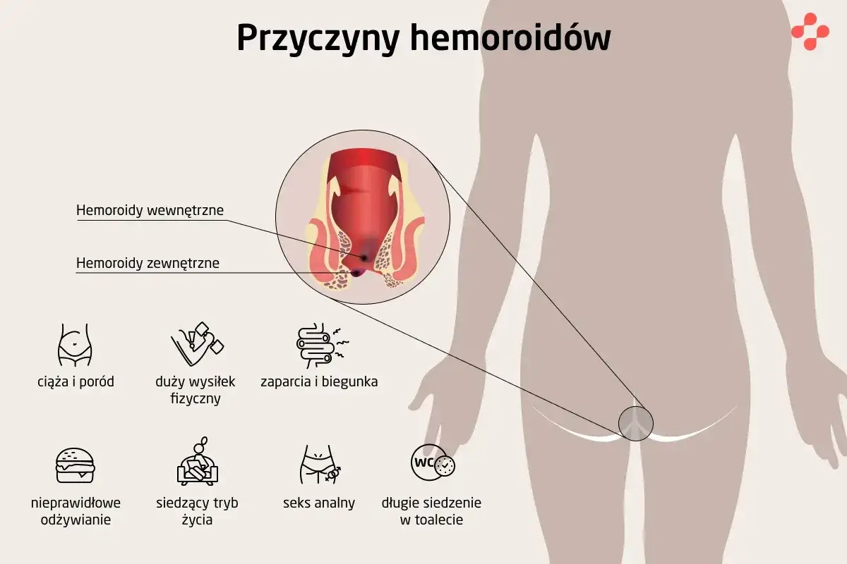 Hemoroidy - co naprawdę je powoduje? Poznaj ukryte przyczyny!