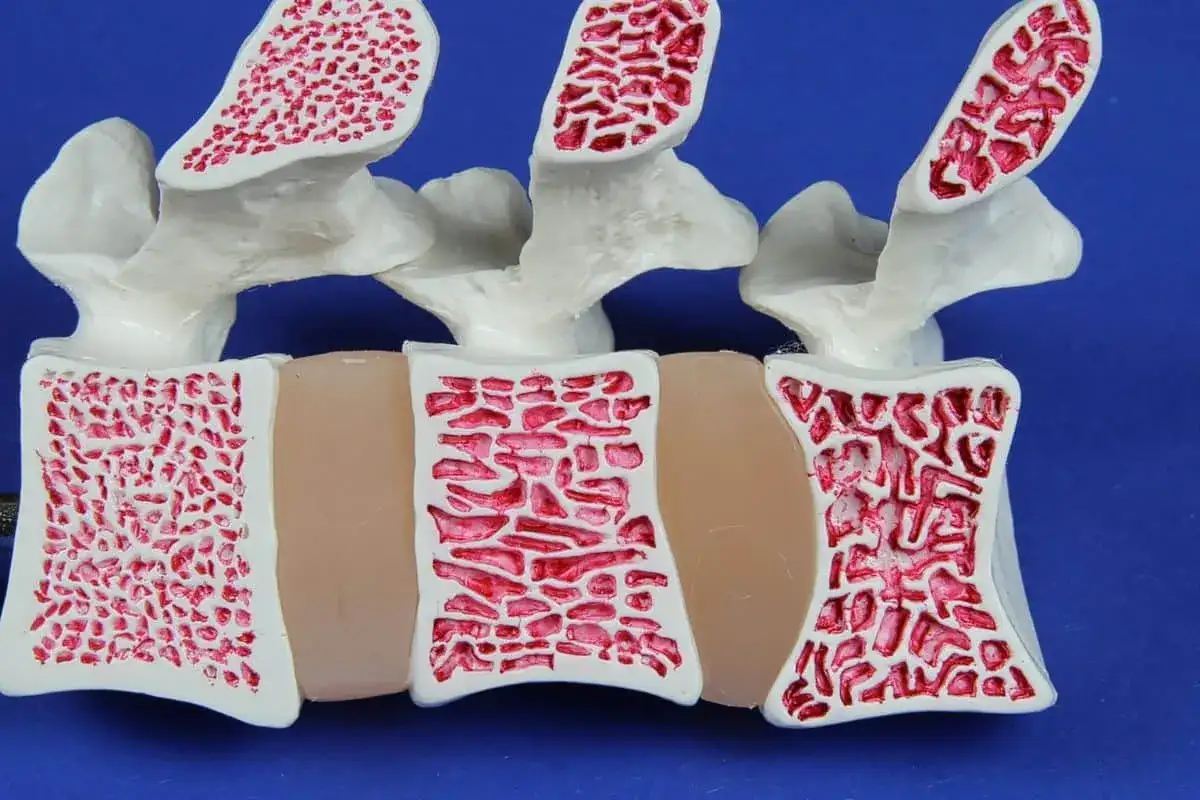 Osteopenia - czy może się cofnąć? Popraw gęstość kości!