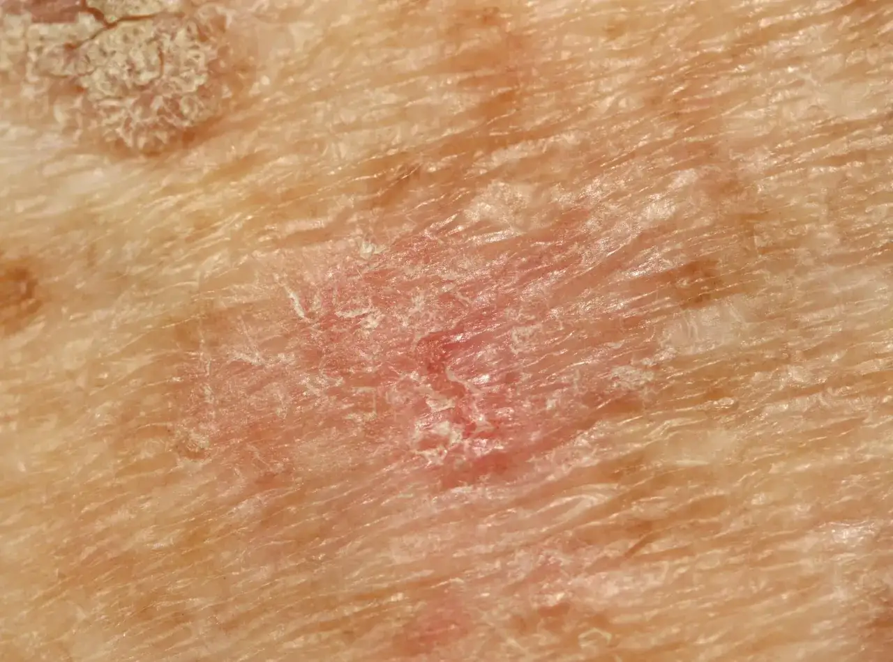 Aktinische Keratose - Was tun bei rauer Haut?