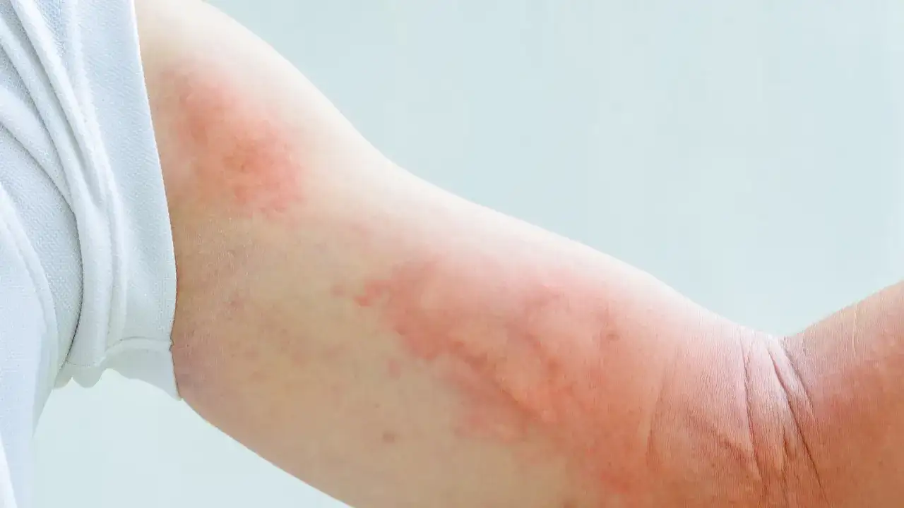 Czerwone plamy na skórze - Kiedy do dermatologa?