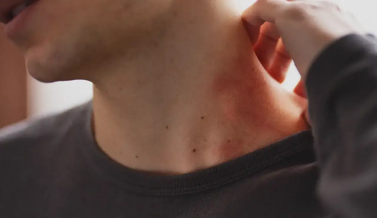 Stries rouges sur la peau - causes, soins et traitements utiles