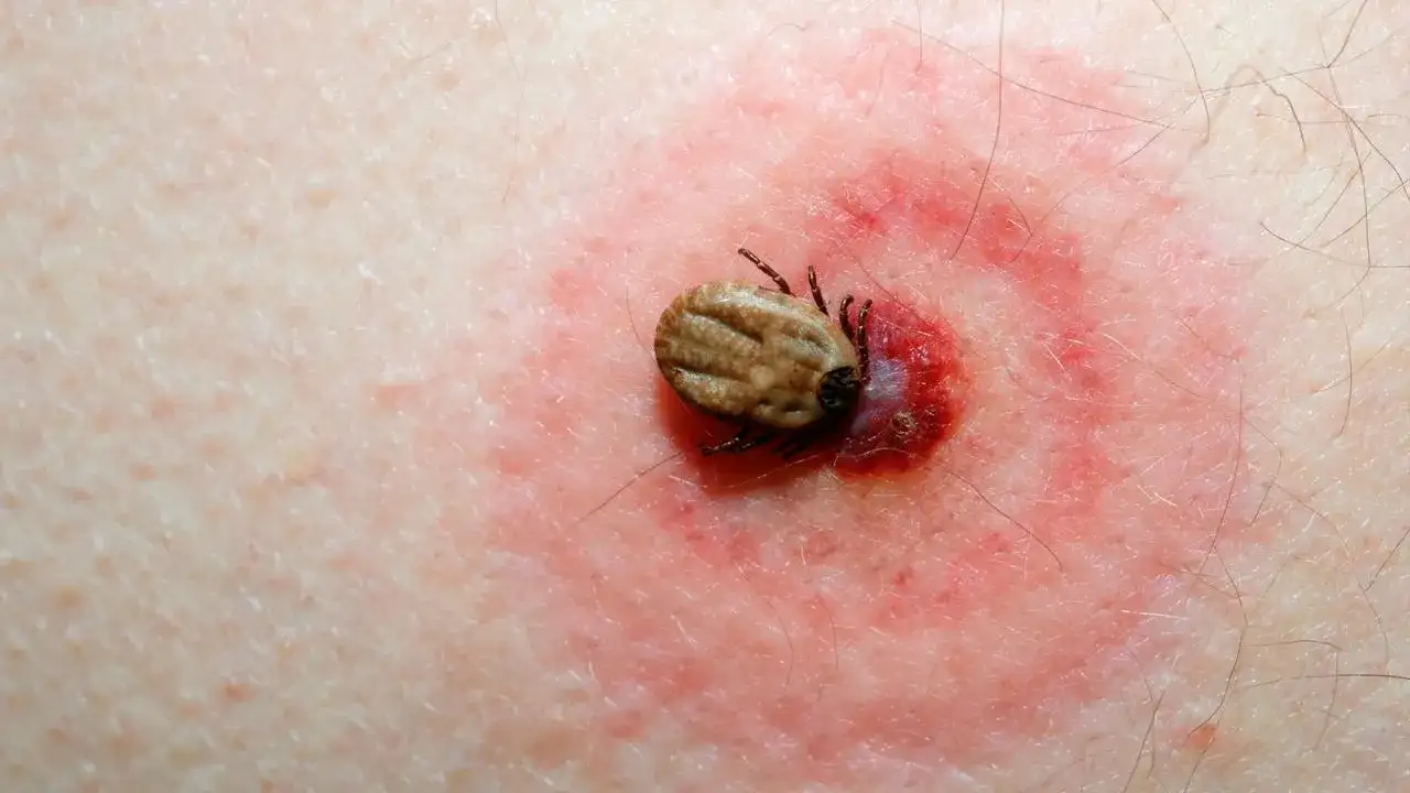 Cómo se llama la enfermedad de las garrapatas y sus riesgos ocultos