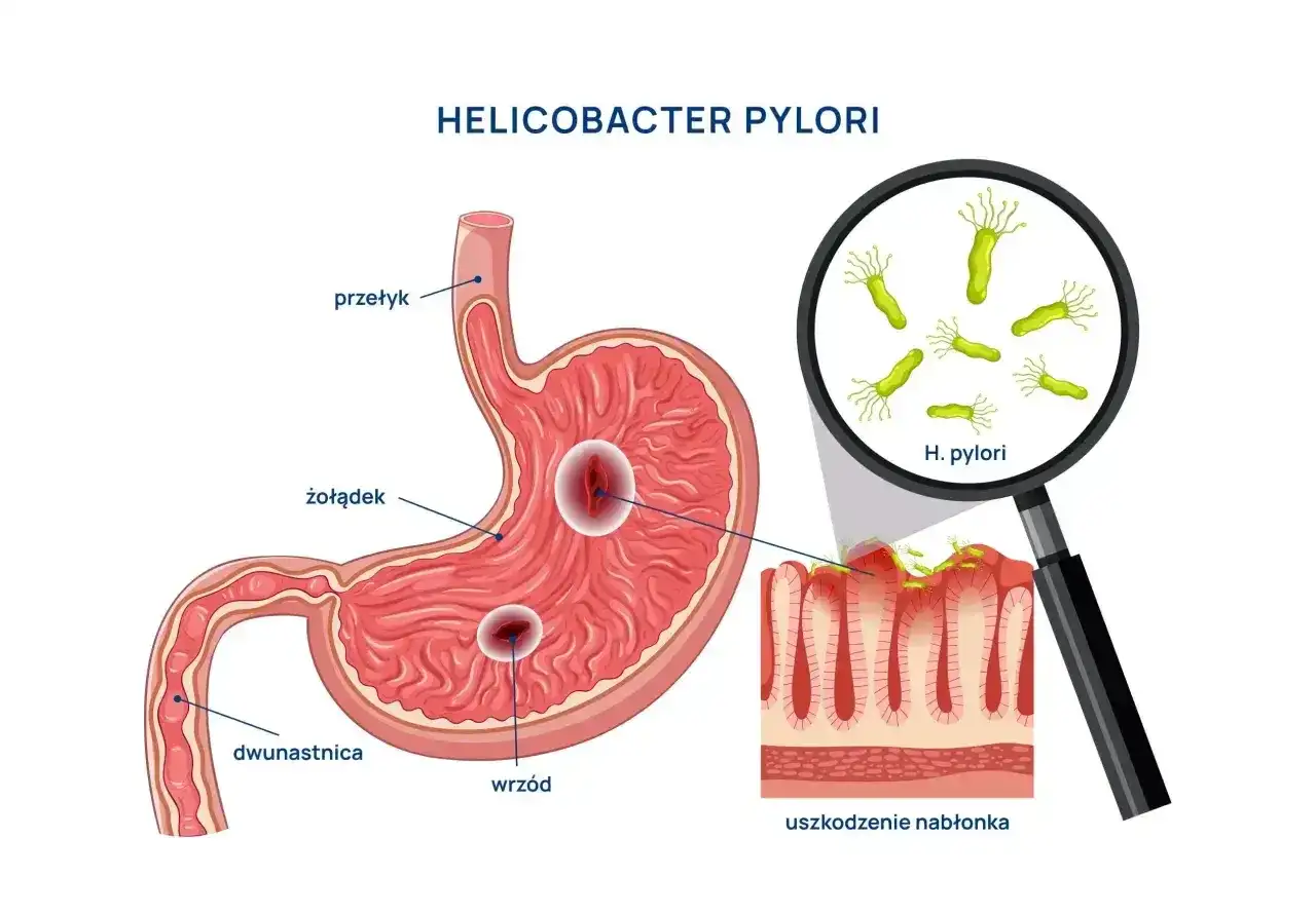 Najskuteczniejszy lek na Helicobacter pylori? Liczy się schemat