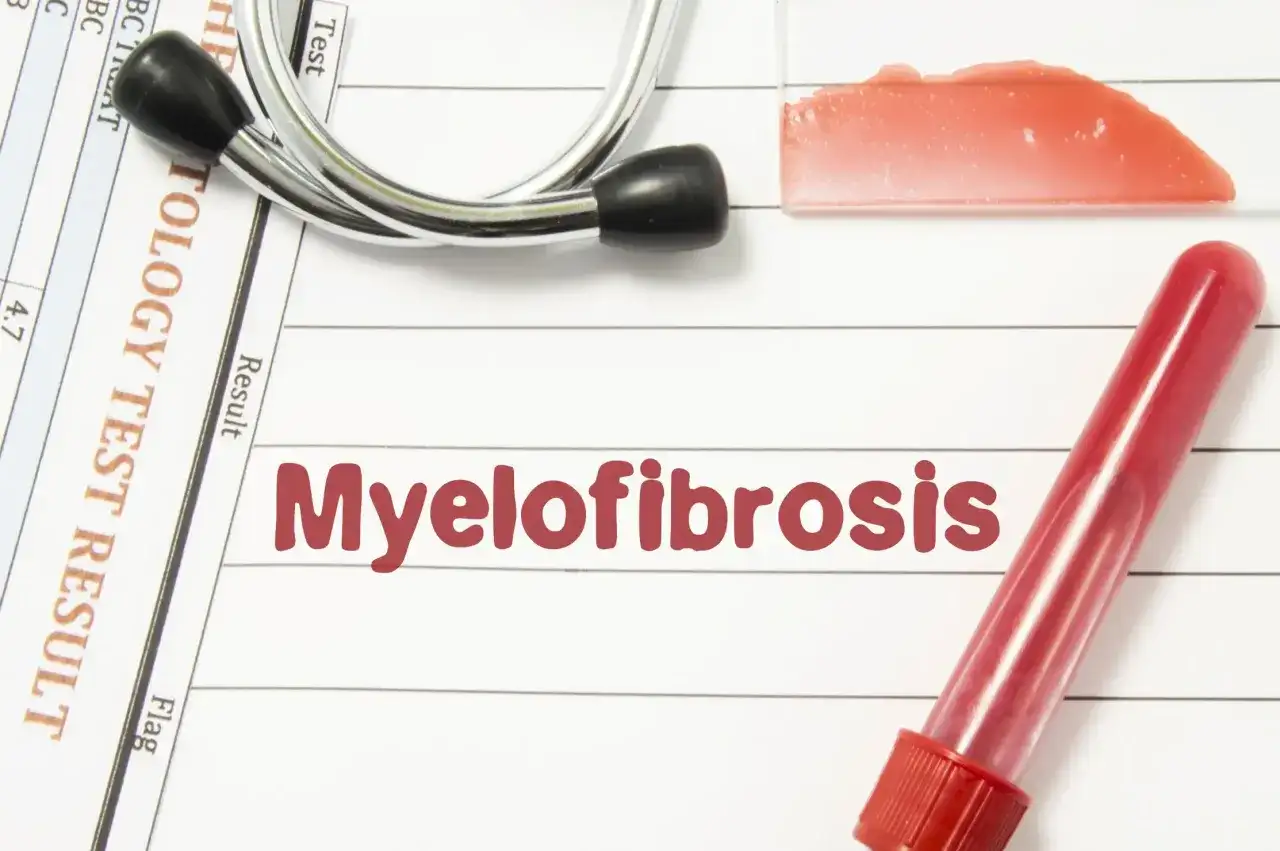 Mielofibroza - objawy, leczenie i diagnostyka. Sprawdź!