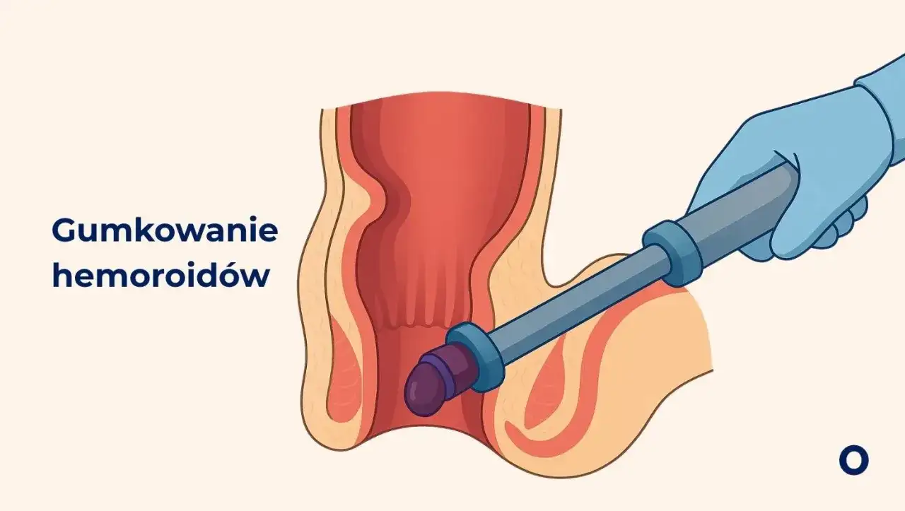 Gumkowanie hemoroidów - Czy to rozwiązanie dla Ciebie?