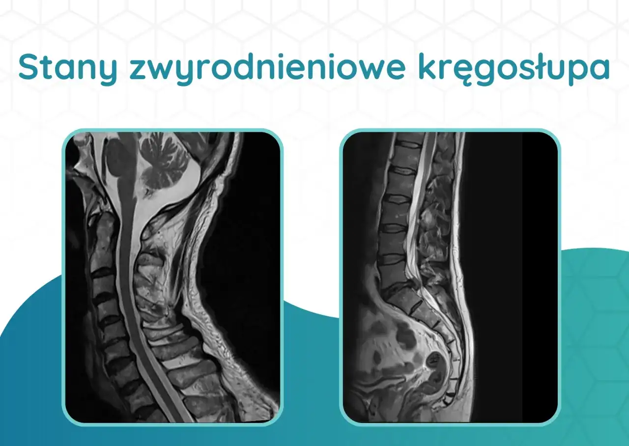 Diagnostyka kręgosłupa - Kiedy RTG, MRI, TK i co z objawami?
