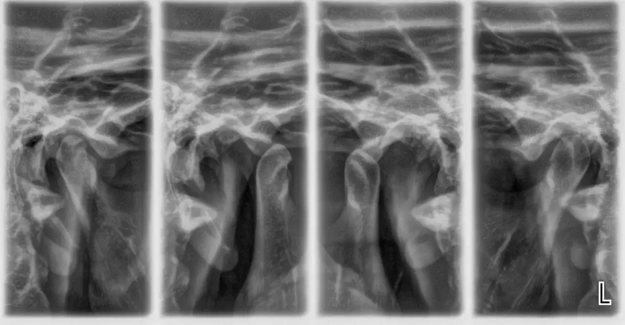 Nowotwór stawu skroniowo-żuchwowego - objawy, diagnostyka