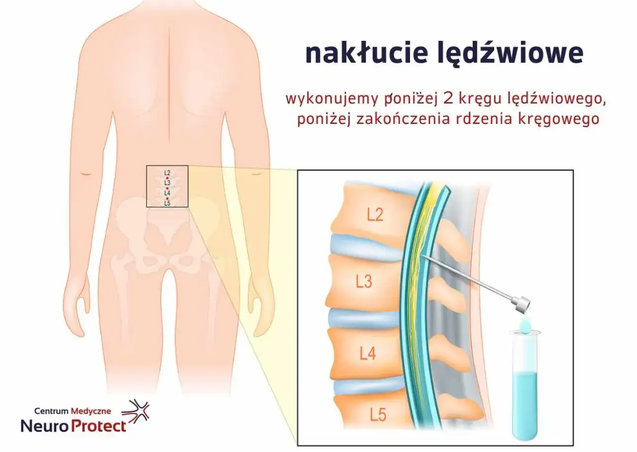 Nakłucie lędźwiowe - co warto wiedzieć przed badaniem