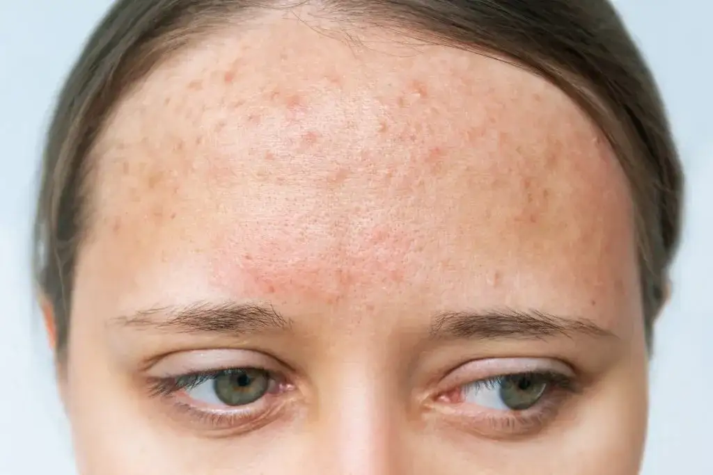 Alergia na mleko u dorosłych: objawy skórne, diagnoza i leczenie