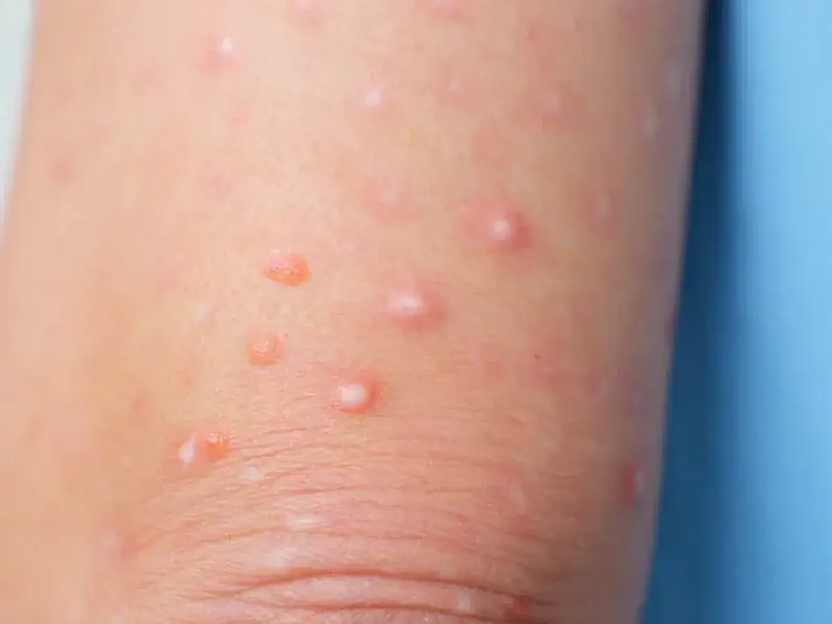 Molusco contagioso en niños, ¿cómo reconocerlo y cuándo tratarlo?