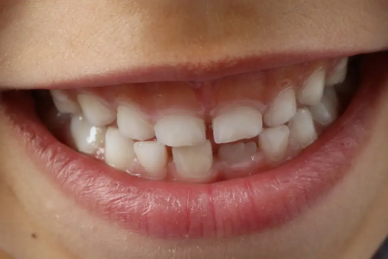 Ząb stały za mleczakiem - kiedy to norma, a kiedy do dentysty?