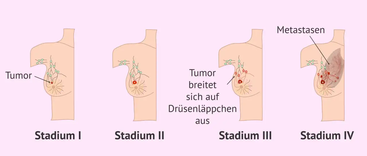 Brustkrebs Stadium III - Prognose, Therapie & Erfahrungen verstehen