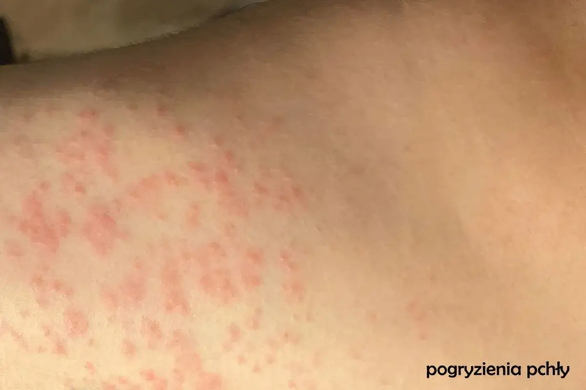 Ślady po pchłach czy pluskwach - Jak rozpoznać różnice na skórze?