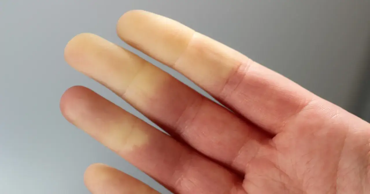 Objaw Raynauda - kiedy zimne palce to coś więcej?
