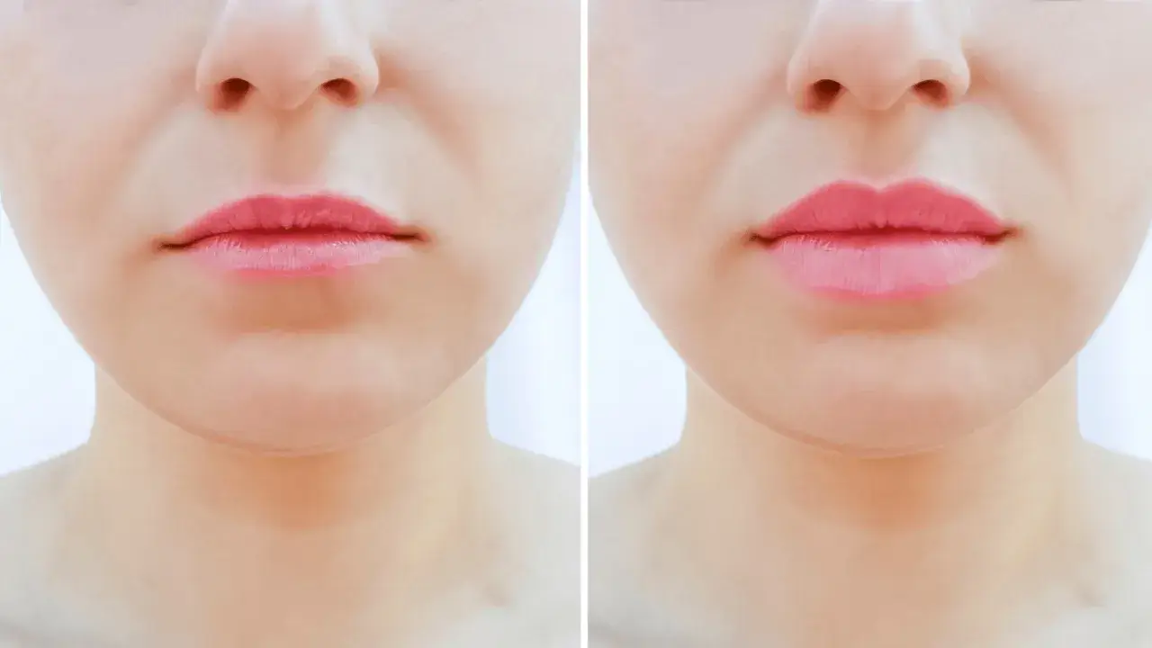 Przed i po zabiegu botox lip flip. Usta stały się pełniejsze i bardziej zdefiniowane.