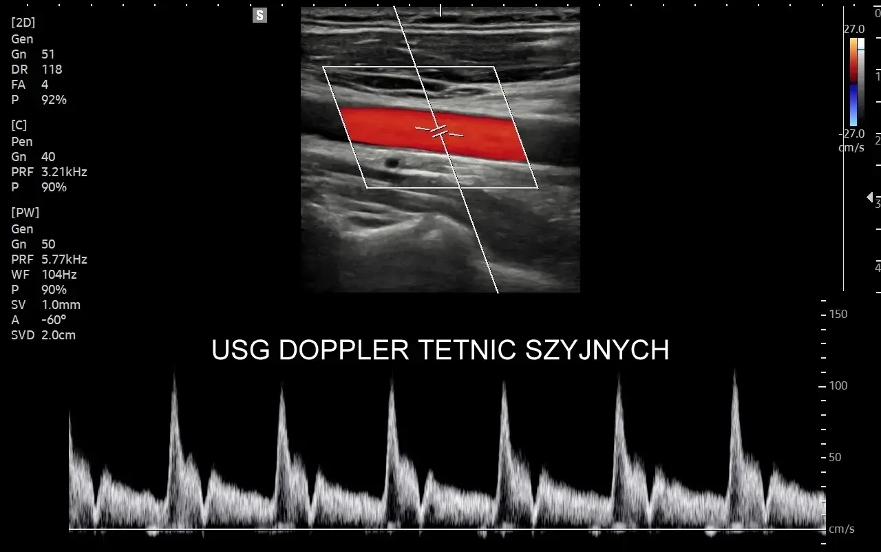 Obraz przedstawia badanie USG doppler tętnic szyjnych z widocznym przepływem krwi w czerwonych i niebieskich barwach oraz wykresem prędkości.