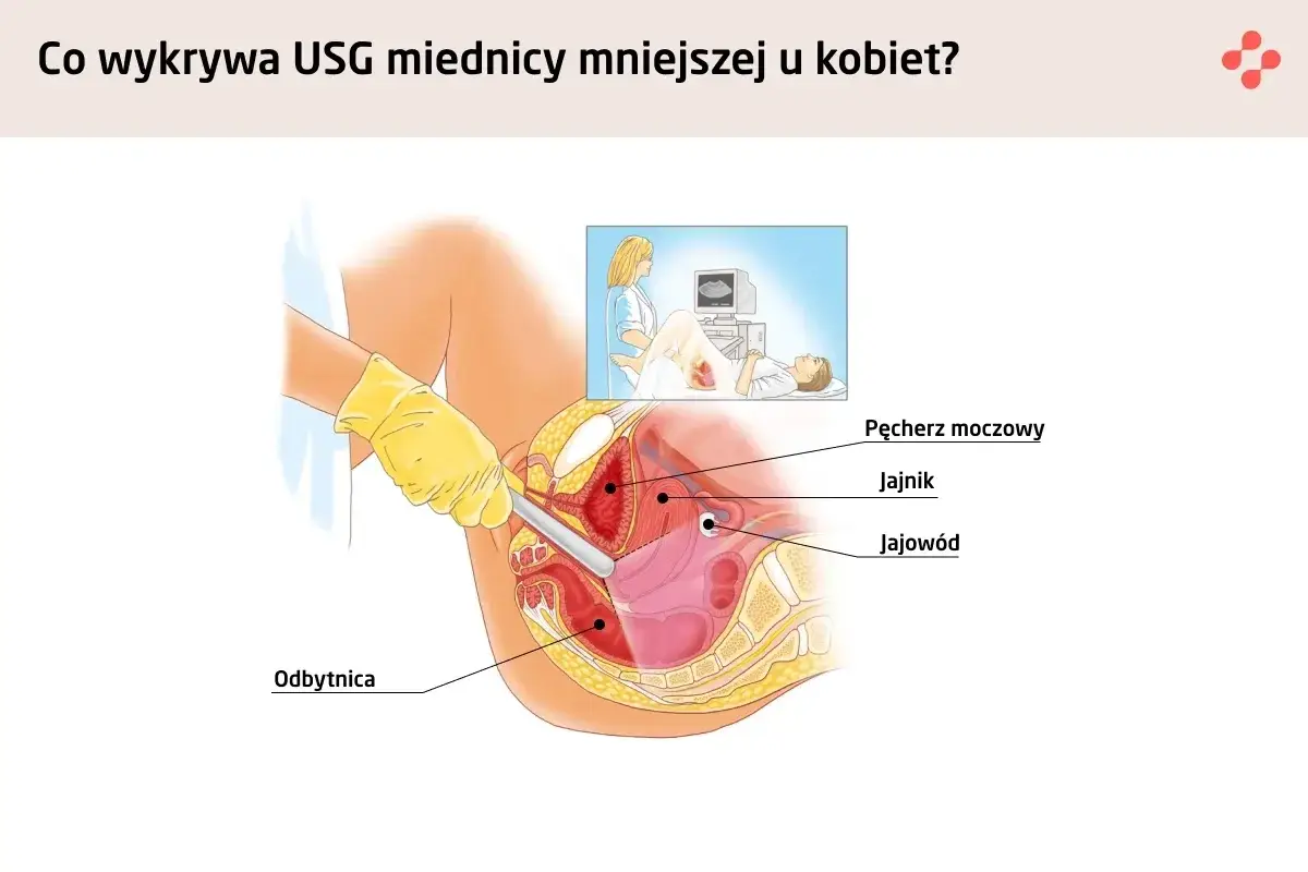 Ilustracja pokazuje, jak wygląda macica podczas badania USG. Widoczne są pęcherz moczowy, jajnik, jajowód i odbytnica.