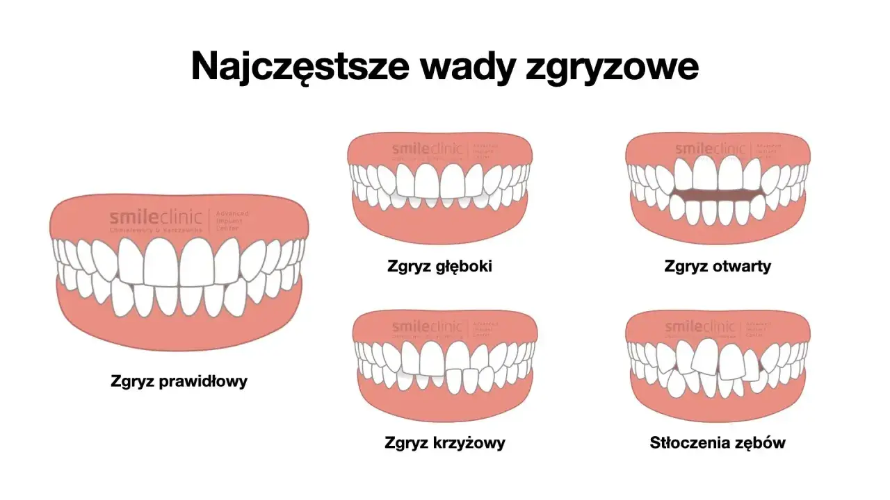 Ilustracje pokazują różne wady zgryzu: prawidłowy, głęboki, otwarty, krzyżowy i stłoczenia zębów.