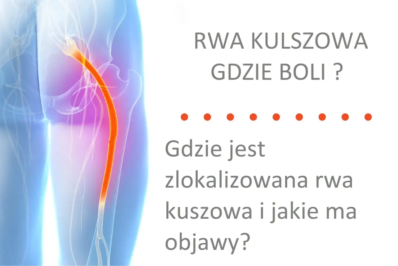 Ból kręgosłupa lędźwiowego promieniujący do nóg - rwa kulszowa. Ilustracja pokazuje przebieg nerwu kulszowego.