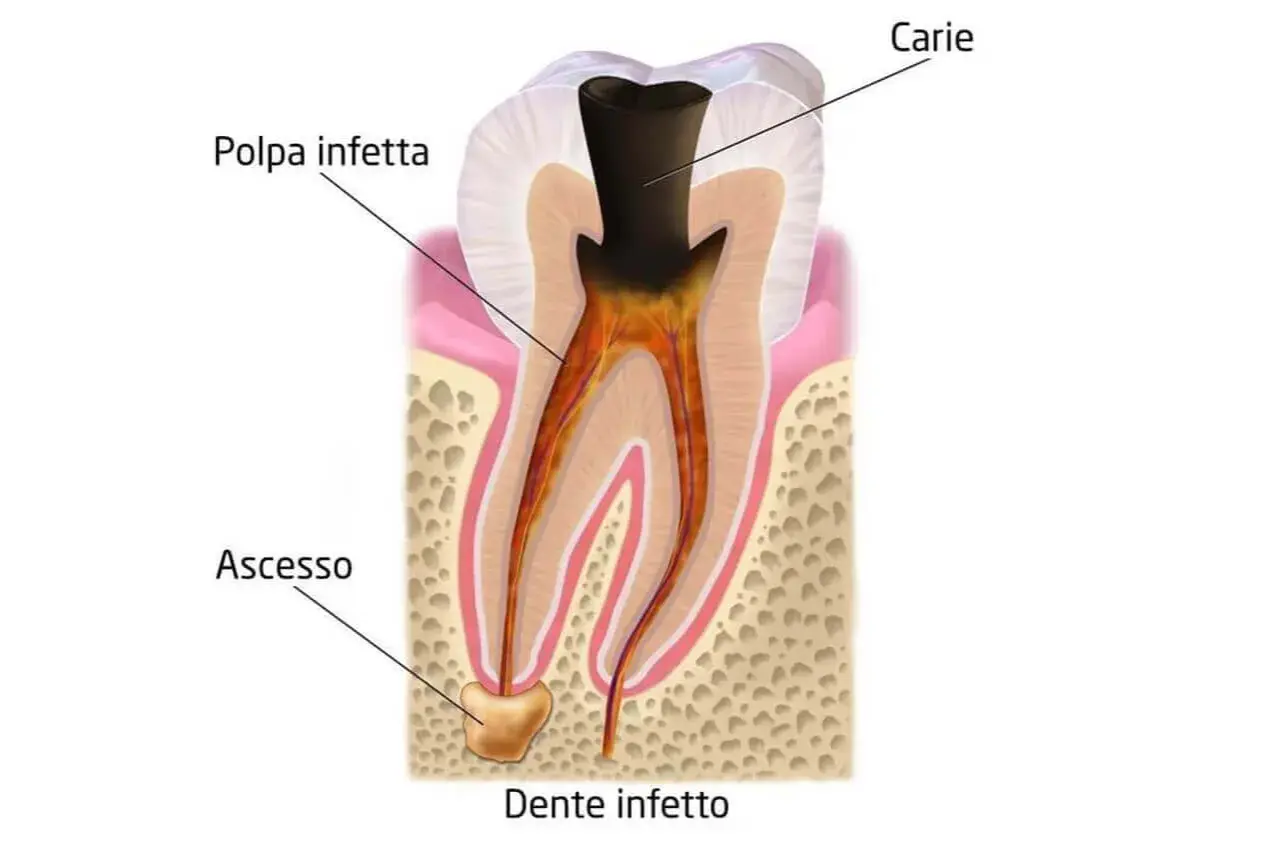 Sezione di un dente con carie e polpa infetta. Alla base della radice si nota un ascesso, segno di infezione.