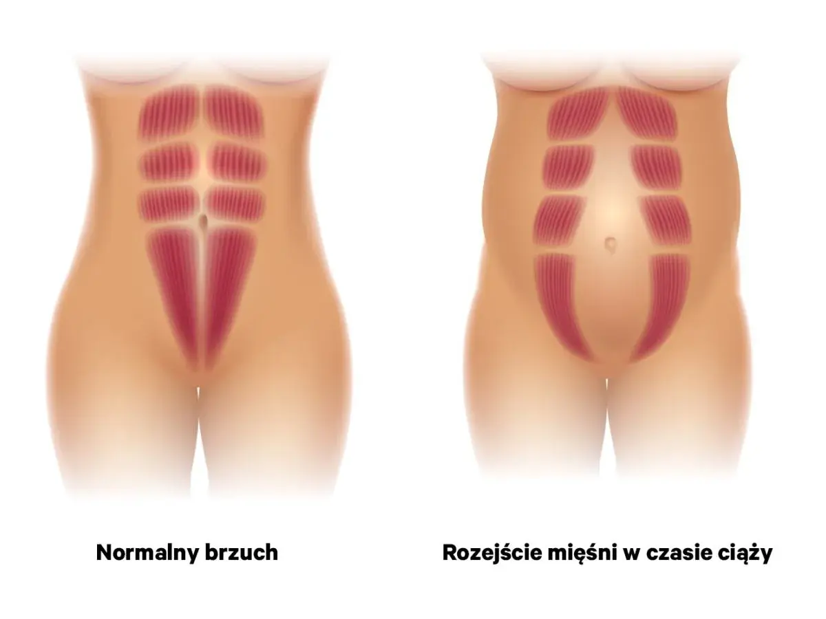 Ilustracja porównuje normalny brzuch z rozejściem mięśni brzucha w czasie ciąży, pokazując rozdzielenie mięśni prostych brzucha.