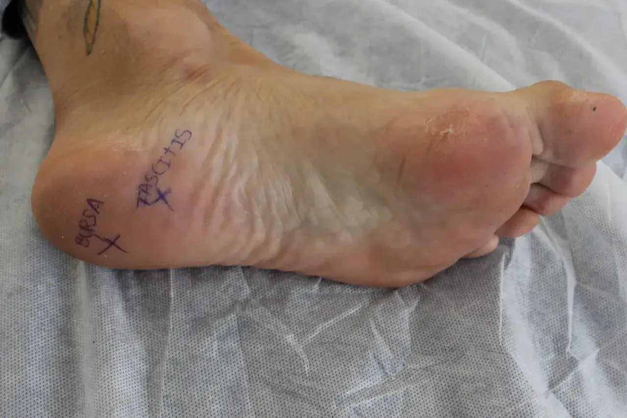 Marcado en el pie, "BURSA" y "FASCITIS" indican áreas de dolor, sugiriendo bursitis y fascitis plantar.