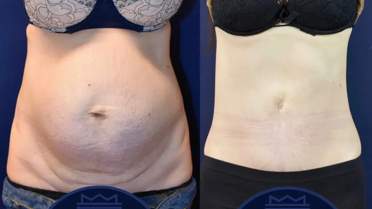 Före- och efterbilder visar tydliga fettsugning resultat på magen. Huden är slätare och midjan smalare.