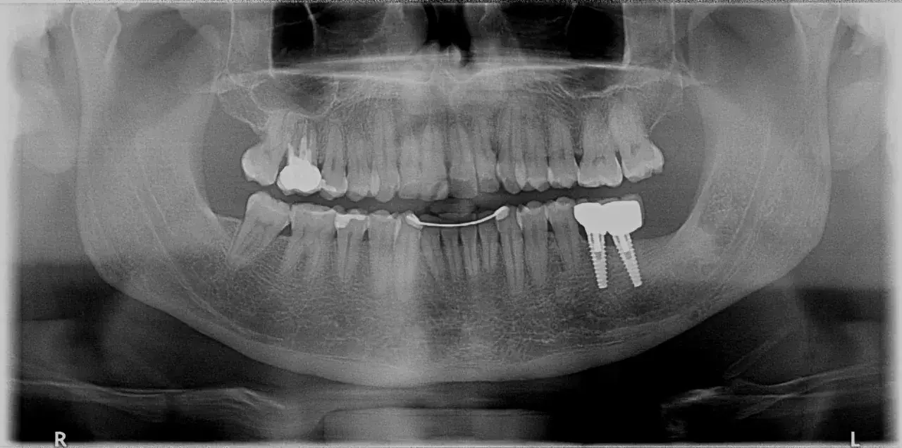 Radiografia panoramica dentale mostra impianti dentali e una protesi. Si nota una sacca gengivale in corrispondenza di un dente.
