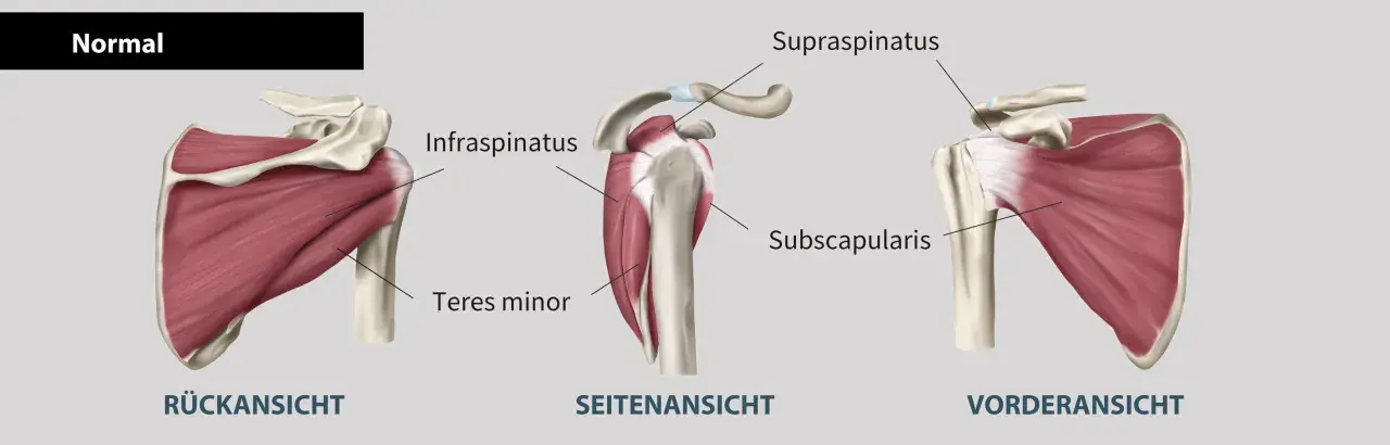 Schulteransichten: Rück-, Seiten- und Vorderansicht zeigen Muskeln wie Infraspinatus, Subscapularis und Teres minor. Bei Schmerzen im Teres minor ist eine genaue Diagnose wichtig.