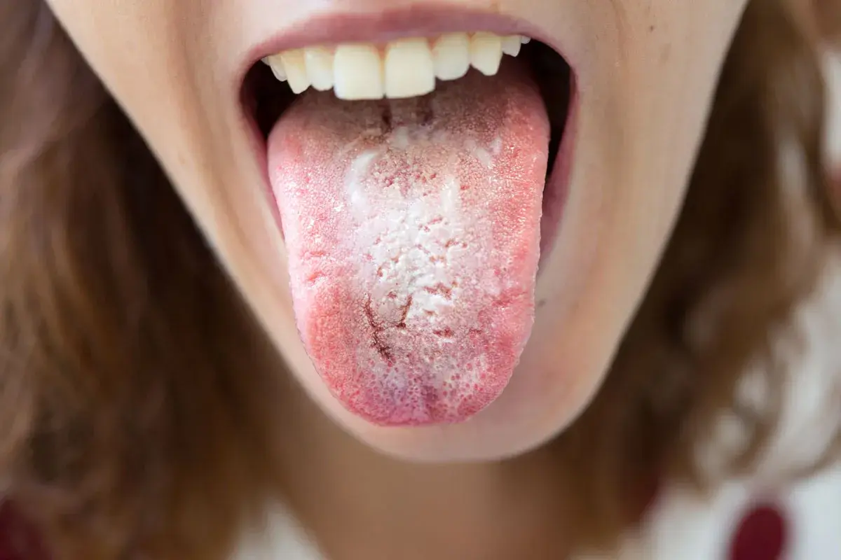 Lingua con placche biancastre, segno di candida in bocca.