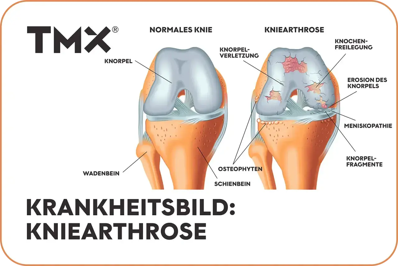 Vergleich von gesundem Knie und Kniearthrose. Die Darstellung zeigt Knorpelverschleiß, Erosionen und Knochenreizungen – eine mögliche "wunderwaffe gegen arthrose knie" könnte hier Abhilfe schaffen.