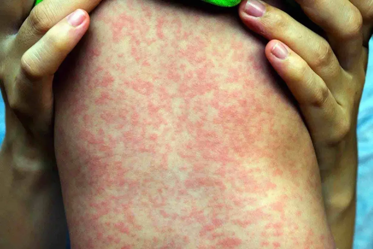 Macchie rosse sulla pelle bambini, un'eruzione cutanea diffusa che potrebbe richiedere attenzione medica.