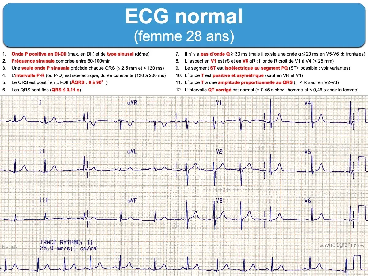 Électrocardiogramme (ECG) d'une femme de 28 ans, montrant un cycle cardiaque normal avec des ondes P, QRS et T caractéristiques.