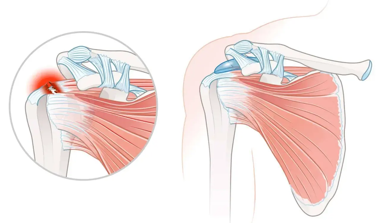 Schulteransicht mit Darstellung einer Tendinopathie der Supraspinatussehne, die entzündet und gerissen ist.