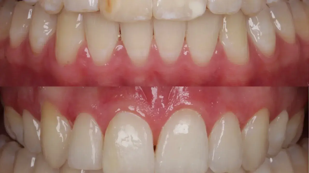 Zdrowe, białe zęby po leczeniu próchnicy u dzieci bez borowania. Uśmiech pełen blasku!