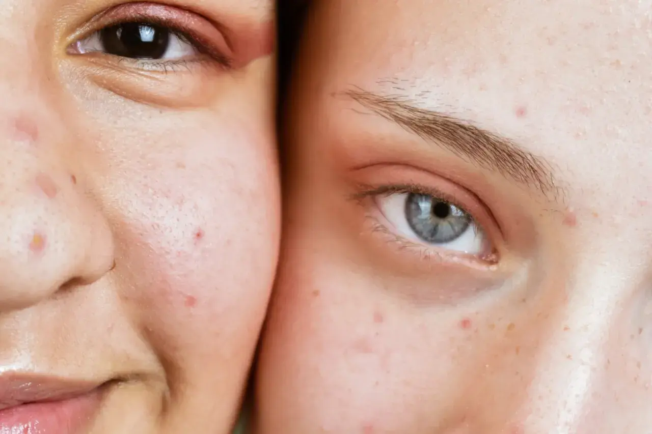 Visages de deux personnes montrant des imperfections cutanées, possiblement des maladies de peau dues au stress.