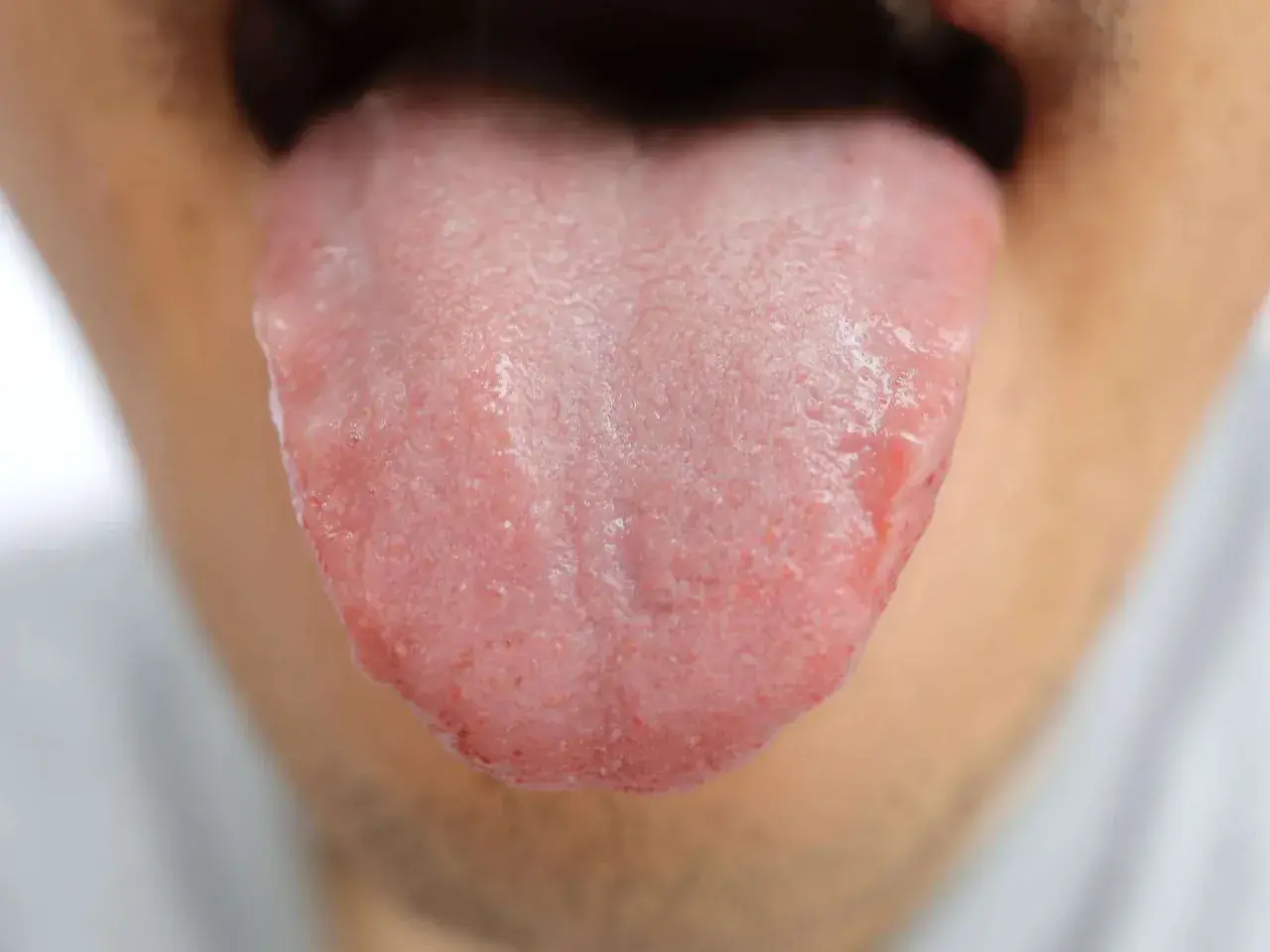 Lingua arrossata e irritata, con papille evidenti, che suggerisce un bruciore alla lingua.