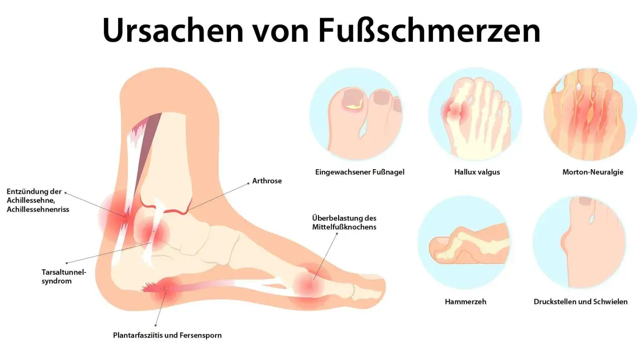 Illustration zeigt Ursachen von Fußschmerzen: Achillessehnenentzündung, Hallux valgus, Morton-Neuralgie, Hammerzeh, Fersensporn und mehr.