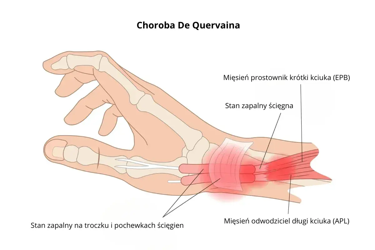 Anatomia dłoni z zaznaczonym stanem zapalnym ścięgien kciuka, wskazującym na chorobę De Quervaina. Pomocne przy ćwiczeniach na nadgarstek.