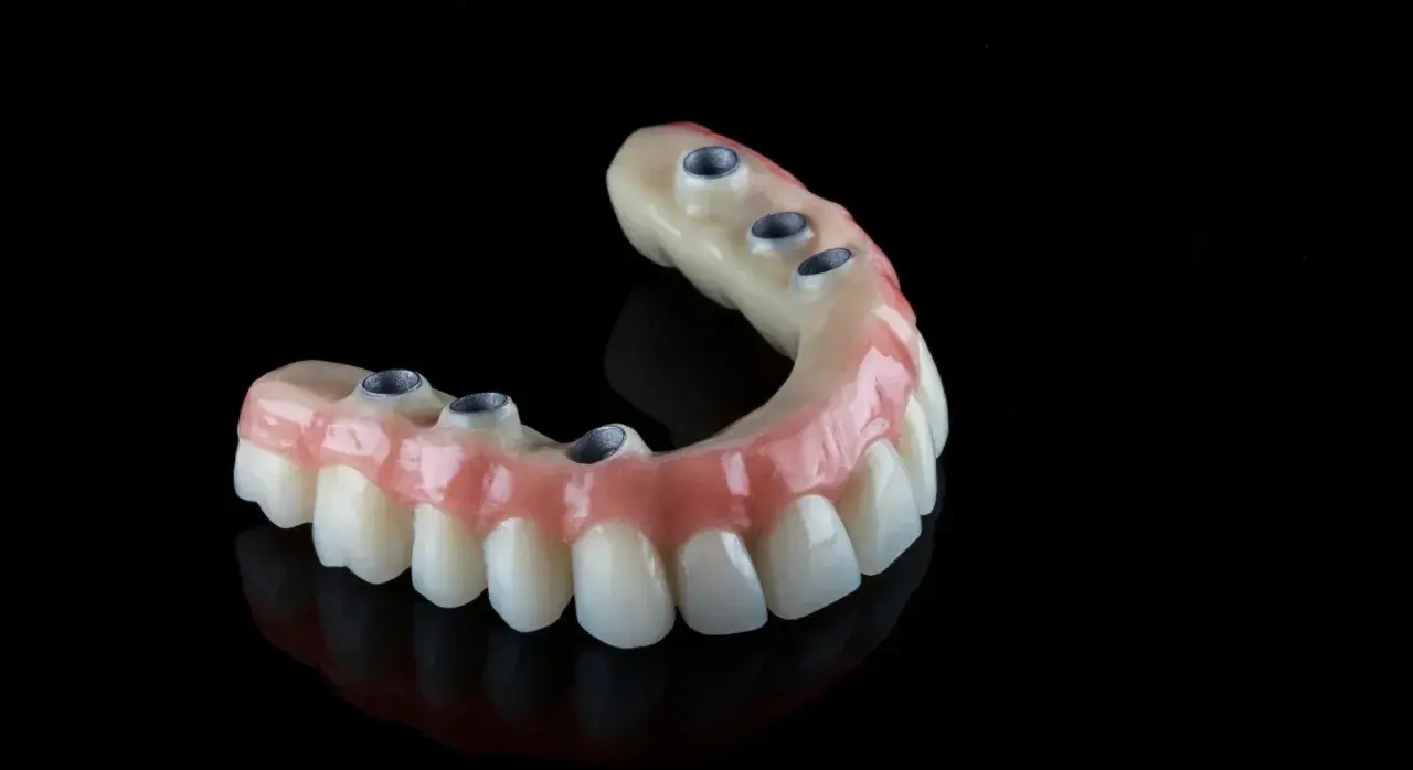 Protesi dentale mobile senza palato, con attacchi metallici per un sorriso fisso e naturale.