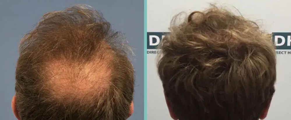 Biotin für Haare: Vorher-Nachher-Ergebnisse & realistische Erwartungen