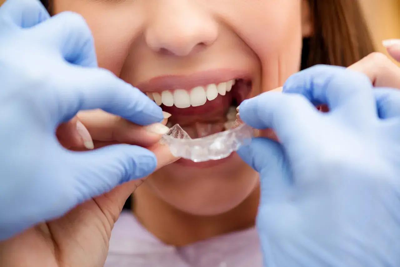 Manos con guantes azules colocan un alineador transparente. La sonrisa de la mujer muestra el progreso de su evolución Invisalign mes a mes.